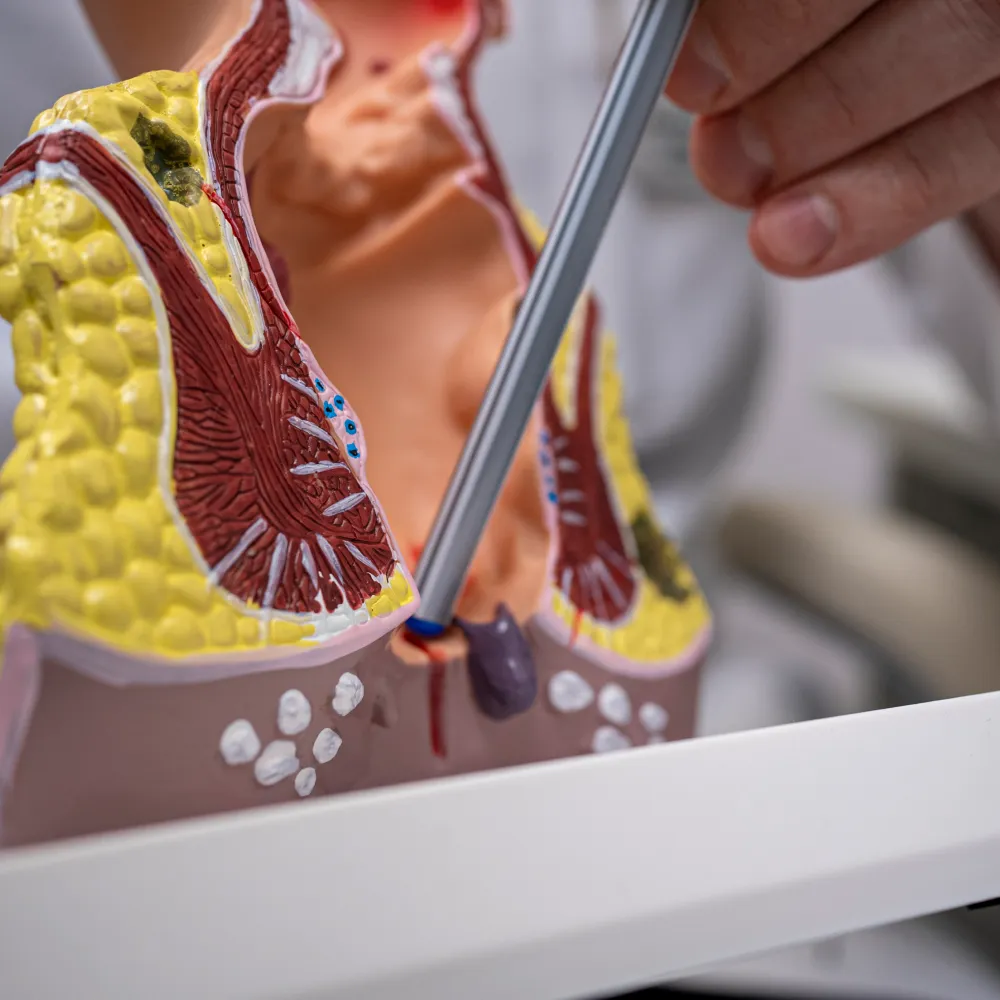 Анальная трещина